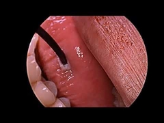 নাক ডাকার চিকিৎসার জন্য রেডিও ফ্রিকোয়েন্সি প্লাজমা জেনারেটর এবং মাল্টি-ফাংশন প্রোব