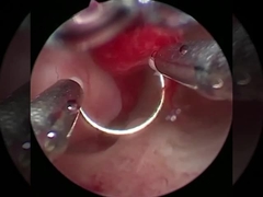 শীতল প্রযুক্তি প্লাজমা সার্জারি ইলেকট্রোড ইউরোলজি জন্য BPH পদ্ধতি